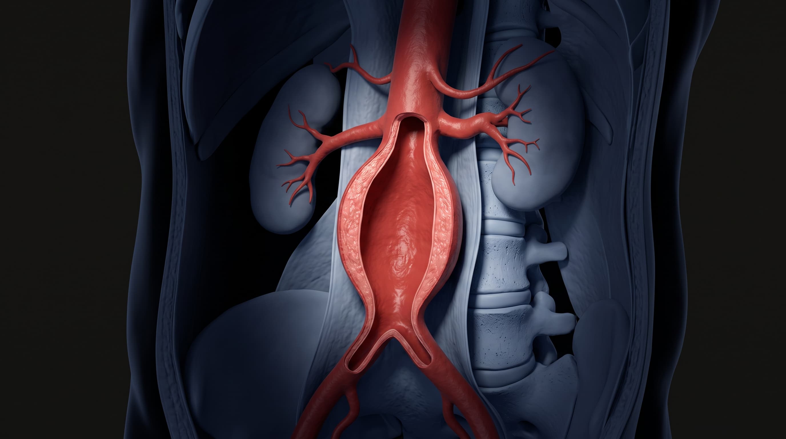 Aneurisma de Aorta Abdominal