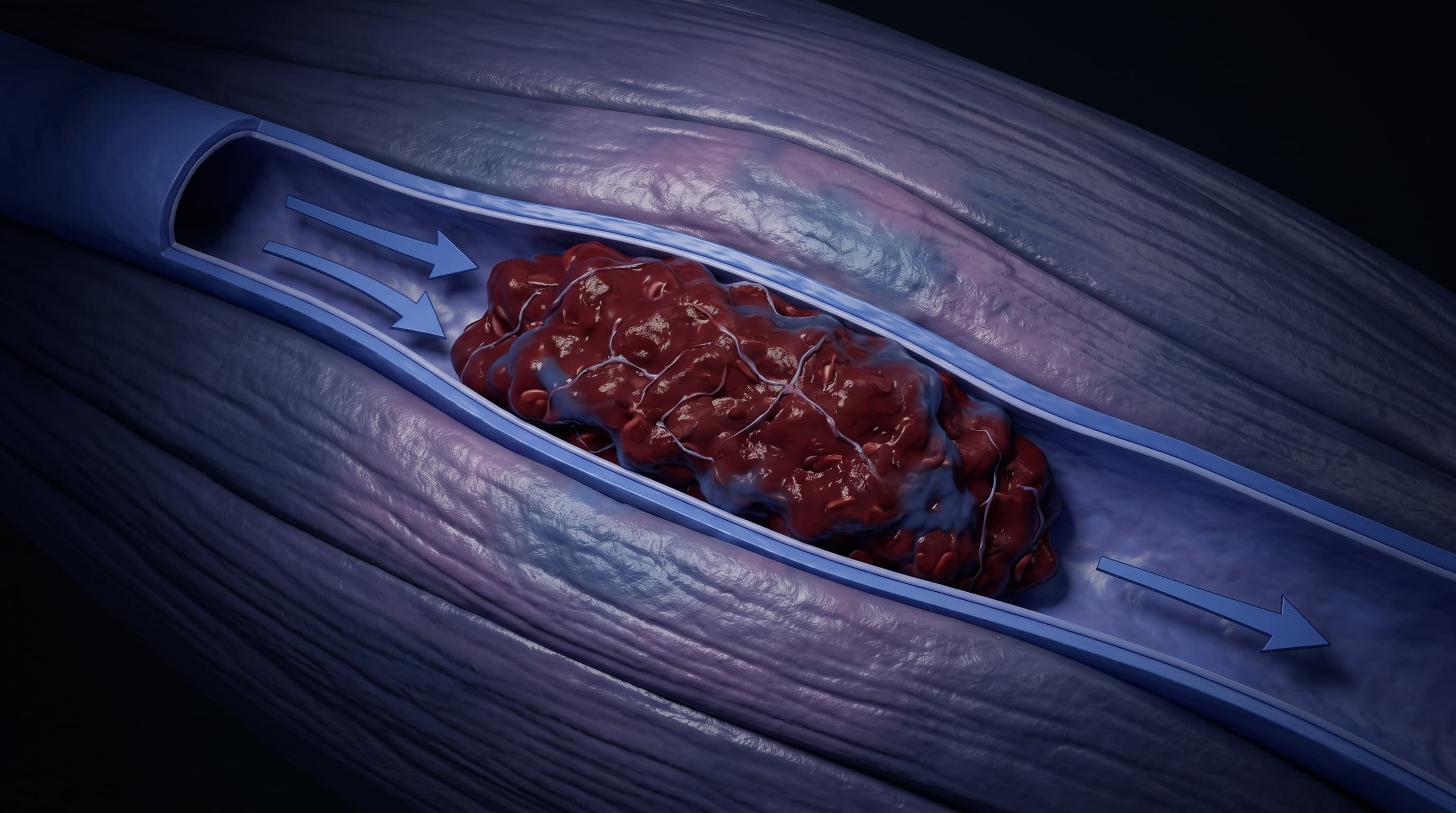 Trombosis Venosa Profunda